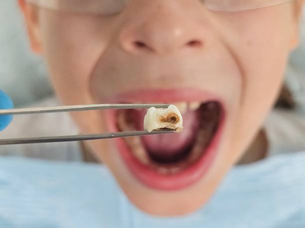Best Emergency Treatment for Oral Infections in Island Walk, FL